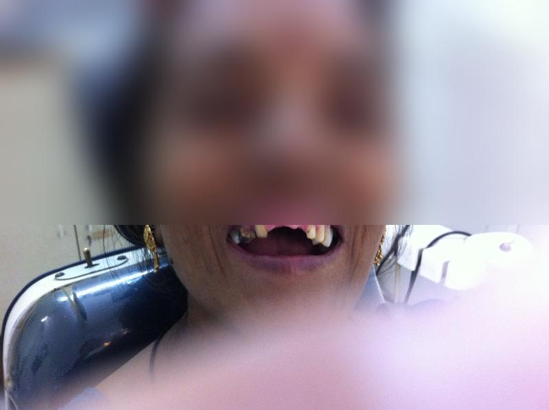 Full Mouth Denture — Before