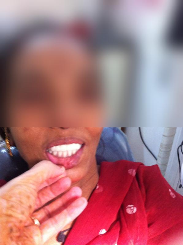 Full Mouth Denture — After