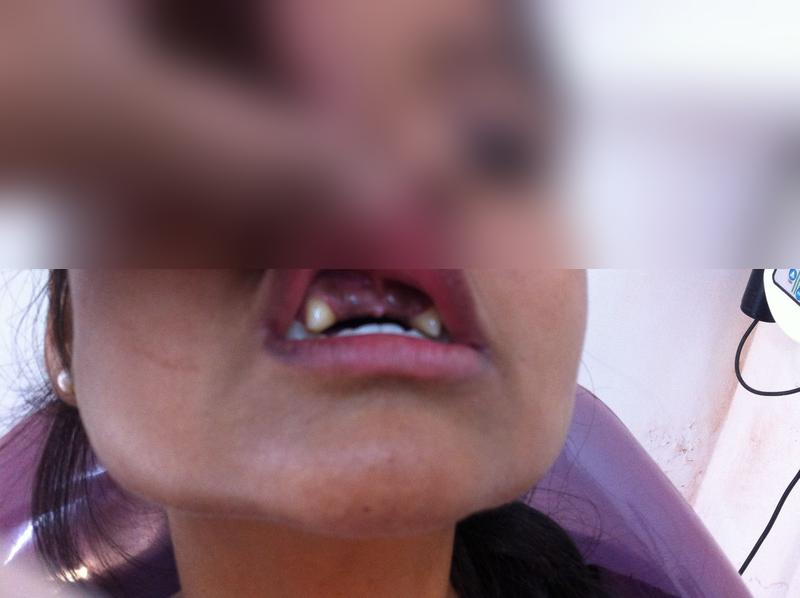 Anterior Teeth Replacement — Before