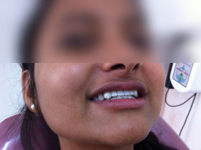 Anterior Teeth Replacement — After