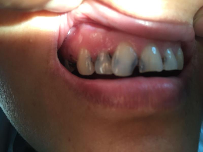 Smile Restoration — Before