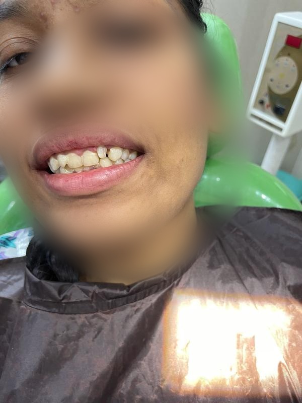 Root Canal + Crown — Before