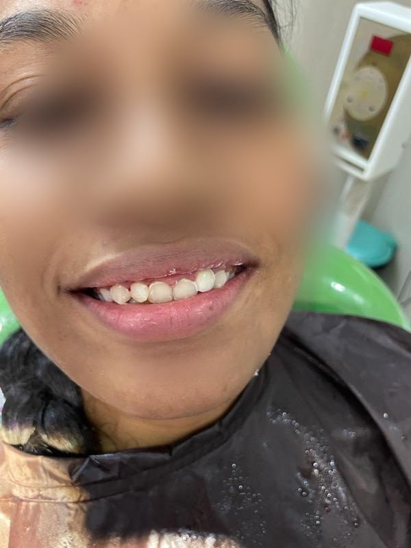 Root Canal + Crown — After