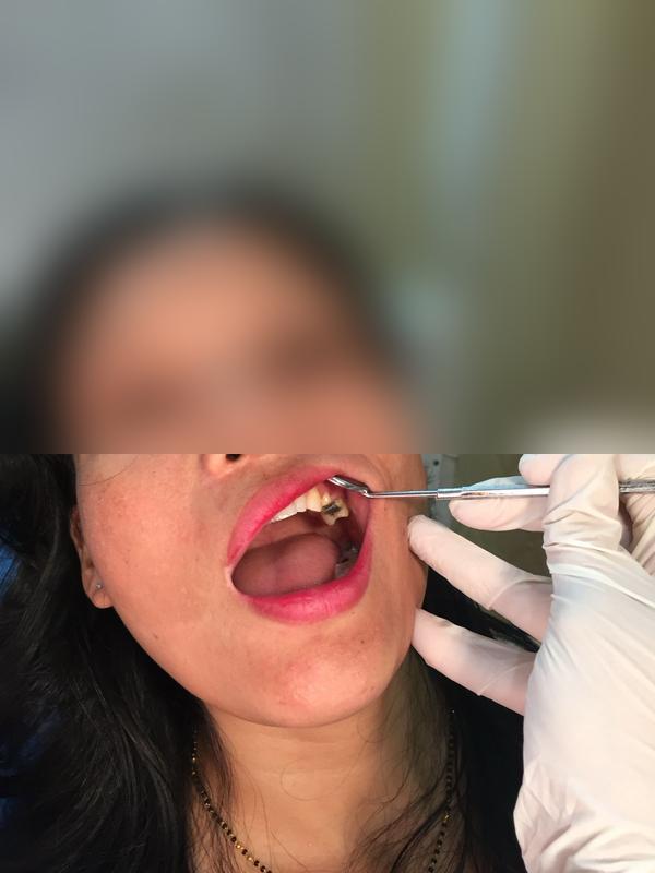 RCT + Zirconia Crown — Before