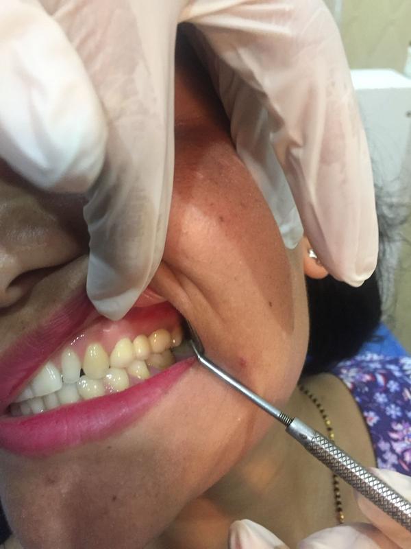 RCT + Zirconia Crown — After