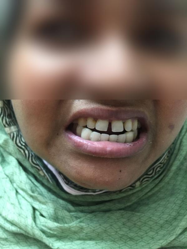 Crown Restoration — After